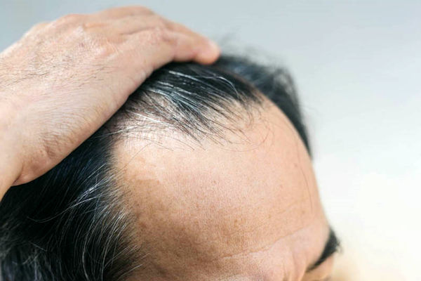 علائمی که نشان دهنده ناموفق بودن کاشت مو است