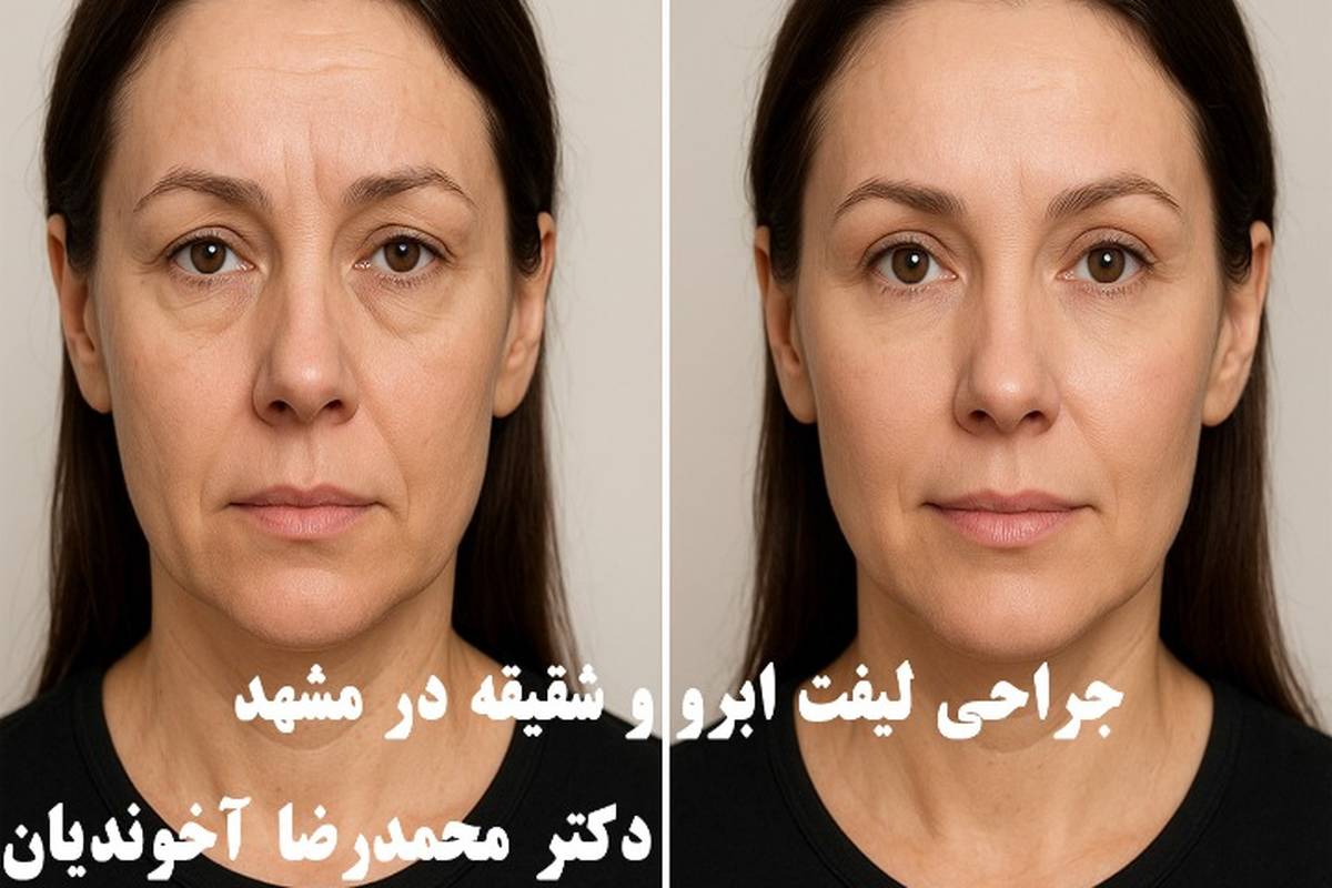 جراحی لیفت ابرو و شقیقه در مشهد با دکتر محمدرضا آخوندیان
