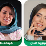 کامپوزیت بهتر است یا لمینت؟ بررسی کامل ویژگی های هر دو روکش