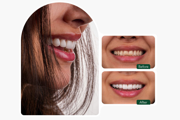 تاثیرات افزایش دلار بر قیمت کامپوزیت دندان 1404