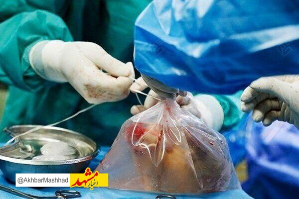 اهدای اعضای بیمار مرگ مغزی مشهدی نجاتبخش جان پنج نفر شد