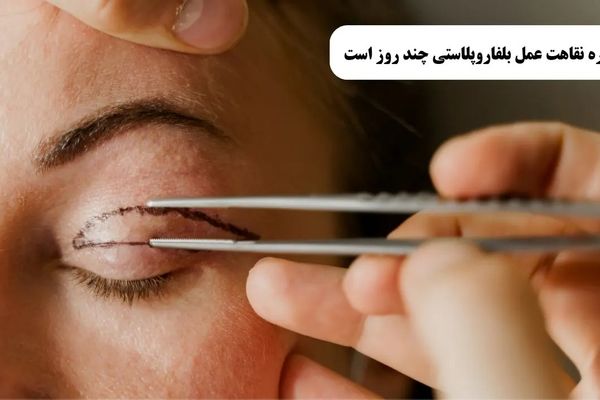 دوران نقاهت بلفاروپلاستی از نگاه پزشکان نوین ایرانا