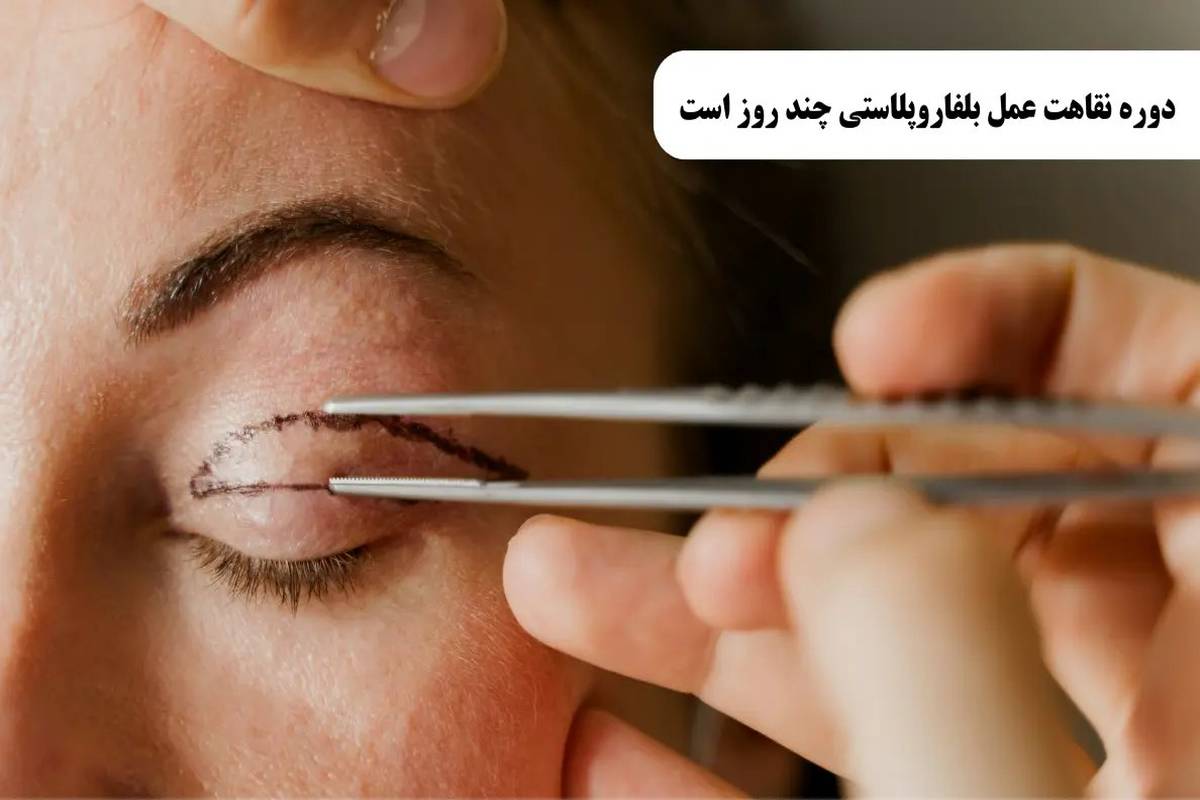 دوران نقاهت بلفاروپلاستی از نگاه پزشکان نوین ایرانا