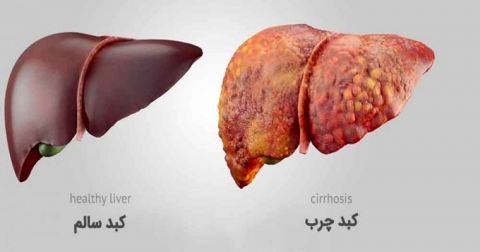 درمان کبد چرب فقط با ۷ خوراکی مفید