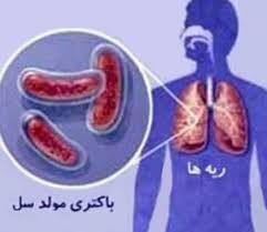 خراسان رضوی رتبه دار ابتلا به سل در کشور