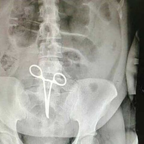 جاماندن پنس در روده های بیمار