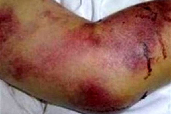 شناسایی۱۰ مورد ابتلا به تب کریمه کنگو در کشور