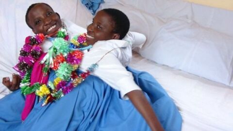 درگذشت دو قلوهای به هم چسبیده در ۲۲ سالگی
