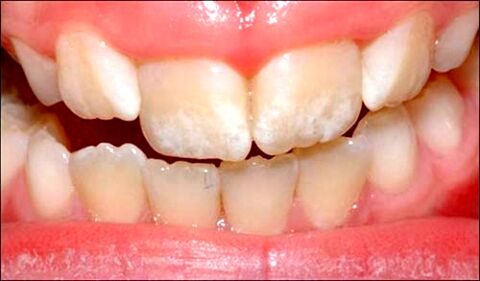 لکه‌های سفید روی دندان چیست؟