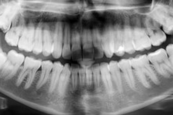 ترمیم مینای دندان بدون پرکردن