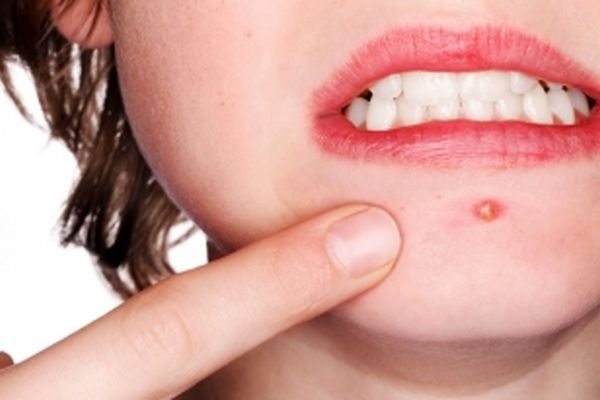 چگونه جوش صورت را درمان کنیم