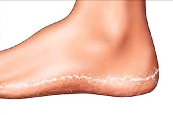 درمان ترک پا با چند ماسک خانگی