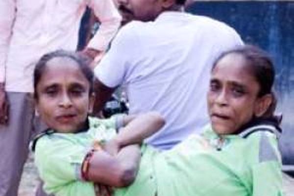 ازدواج خواهران از شکم بهم چسبیده با یک مرد!! +تصاویر