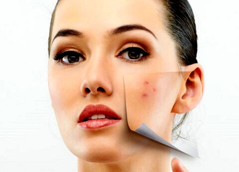نکات مربوط به جوش از دیدگاه طب سنتی