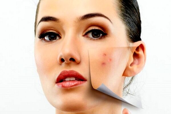 نکات مربوط به جوش از دیدگاه طب سنتی