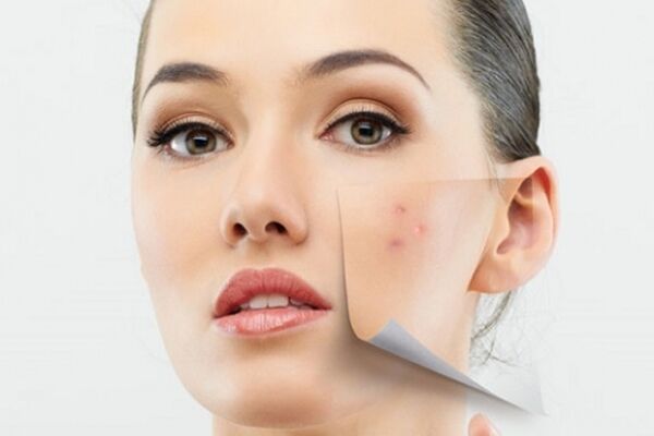 نکات مربوط به جوش از دیدگاه طب سنتی