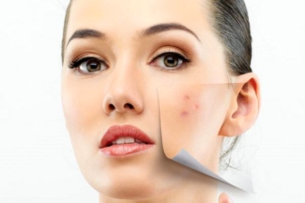 نکات مربوط به جوش از دیدگاه طب سنتی