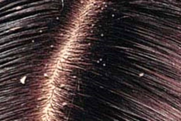 علت شوره سر چیست؟