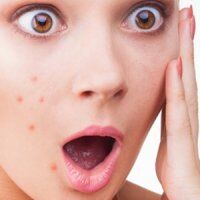 آنچه باید درباره آکنه بدانید؟