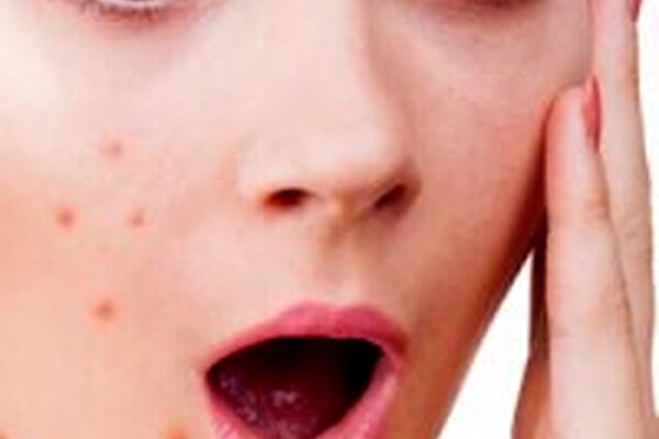 آنچه باید درباره آکنه بدانید؟