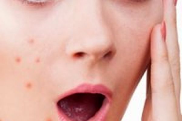 آنچه باید درباره آکنه بدانید؟