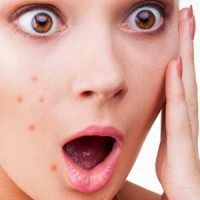 آنچه باید درباره آکنه بدانید؟