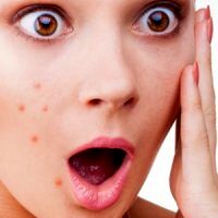 آنچه باید درباره آکنه بدانید؟