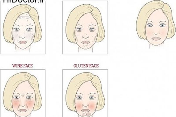 آسیب صورت ناشی از رژیم گرفتن