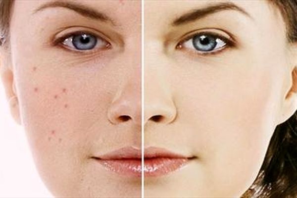 درمان طبیعی آکنه با روغن گیاه گل مغربی