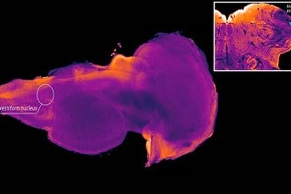 کشف منطقه‌ای ویژه در مغز انسان برای درمان پارکینسون