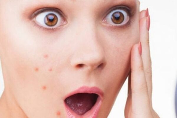 بهترین روش برای درمان جوش صورت