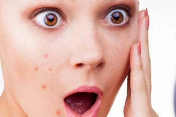 بهترین روش برای درمان جوش صورت