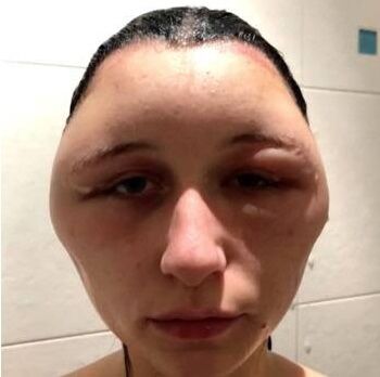 حادثه ای عجیب/ دختری که یکدفعه سرش بزرگ شد+ عکس