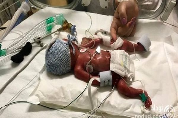 127 روز نا امیدی و بازگشت دوباره به زندگی نوزاد نارس+عکس