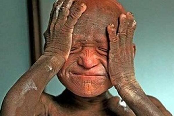 بیماری هولناک / پسر 11 ساله در حال سنگ شدن است! +عکس