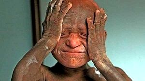 بیماری هولناک / پسر 11 ساله در حال سنگ شدن است! +عکس