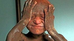 بیماری هولناک / پسر 11 ساله در حال سنگ شدن است! +عکس