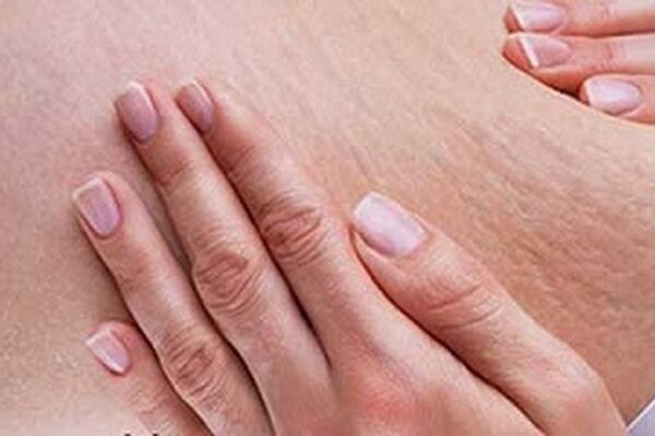 ترک های پوست را از بین ببرید