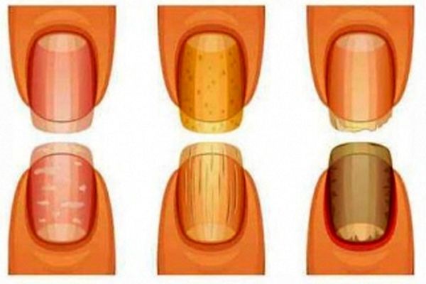 تشخیص بیماری از روی رنگ ناخن
