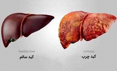 ابتلا به کبد چرب در کمین دیابتی ها