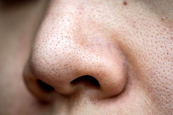 ۸ درمان خانگی برای از بین بردن جوش‌های سرسیاه