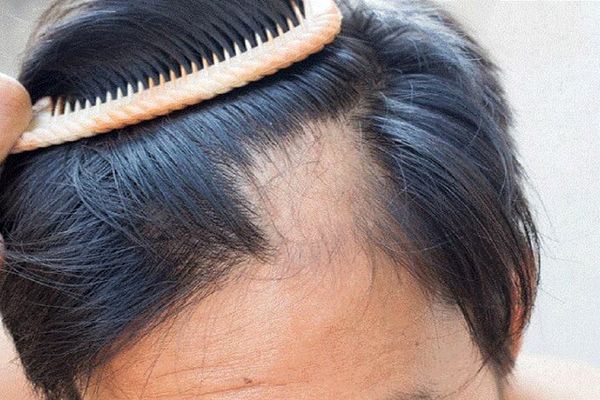 ۳ دسته دارویی که باعث ریزش مو می‌شوند