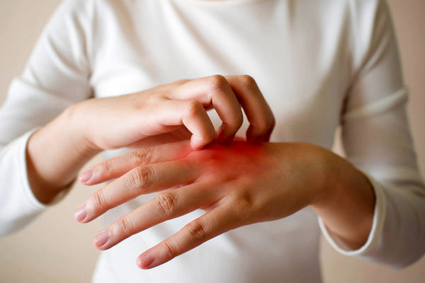 چگونه از تحریکات پوستی پیشگیری کنیم؟