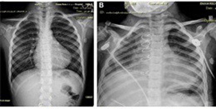 ابداع روش درمانی جدید برای درمان کودکان مبتلا به شیلوتوراکس توسط متخصصان مشهدی