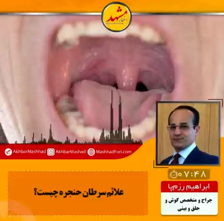 در صورت گرفتگی و تغییر صدا بیشتر از دوهفته، حنجره باید از نظر ابتلا به سرطان بررسی شود