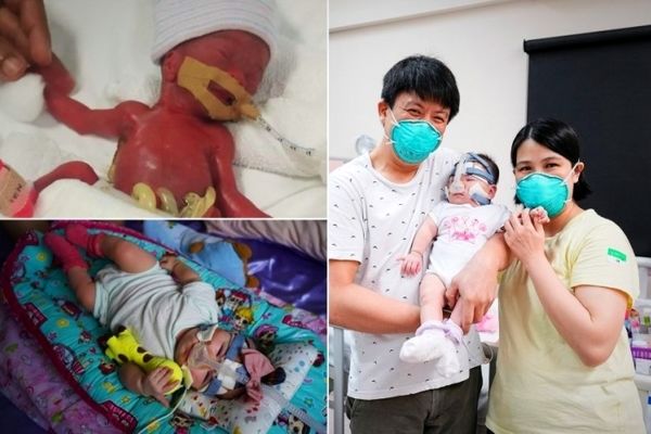 تولد نوزادی هم وزن یک سیب/عکس نوزاد