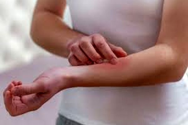 بروز مشکلات پوستی در ۷ درصد بیماران کرونایی