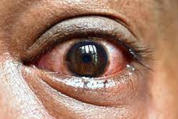 اولین نشانه ابتلا به قارچ سیاه + راه درمان