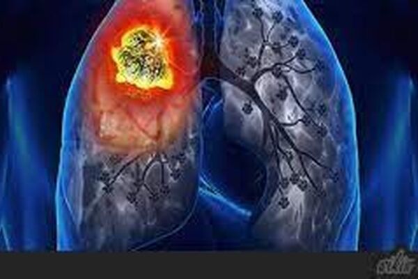 مشخصه مرحله حاد بیماری کرونا افزایش بارز مارکرهای سرمی التهابی است