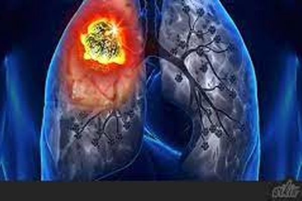 مشخصه مرحله حاد بیماری کرونا افزایش بارز مارکرهای سرمی التهابی است